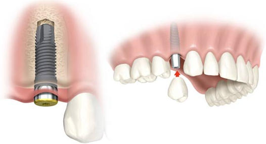 centro de especialidades dentales: implantes, miniimplantes y tratamientos bucales en Fuenlabrada